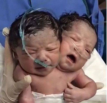Meksikada ikibaşlı uşaq dünyaya gəlib – VİDEO